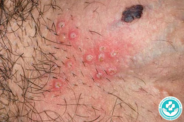 Bệnh hột xoài – Triệu chứng và phương pháp điều trị