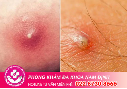 Nổi mụn mủ ở vùng kín là do nguyên nhân gì?