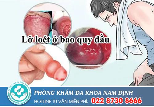 viêm loét bao quy đầu